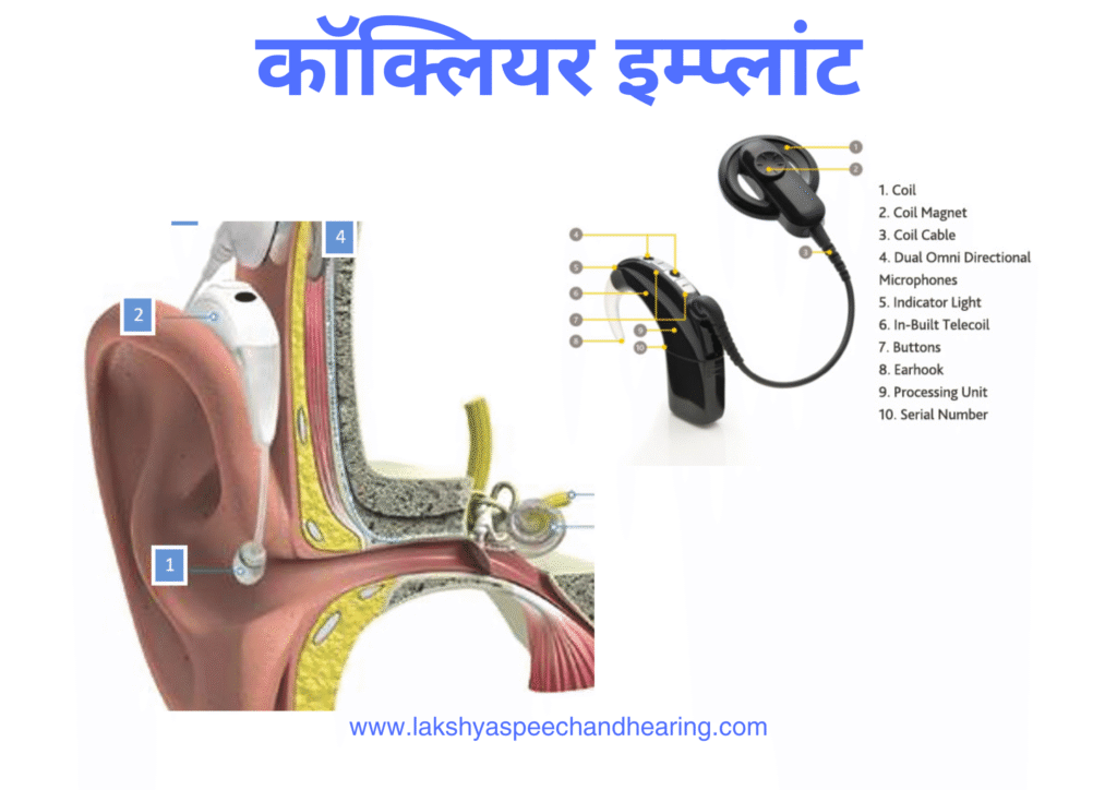 कॉक्लियर इम्प्लांट